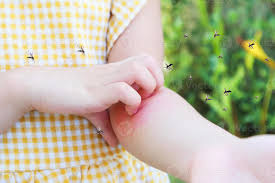 Can Mosquito Bites Cause Hives? Exploring the Relationship Between Mosquito Bites and Urticaria